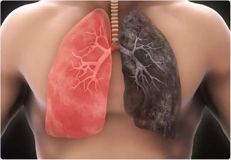 HEALTH TIPS: Why does lung cancer occur in non-smokers, here's what experts say