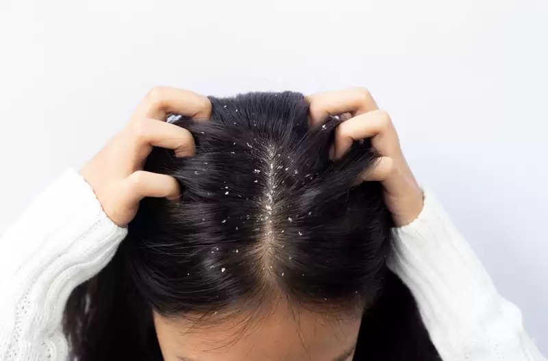 Hair Care Tips: Use castor oil to get rid of dandruff problem in winter,  know how to use it...