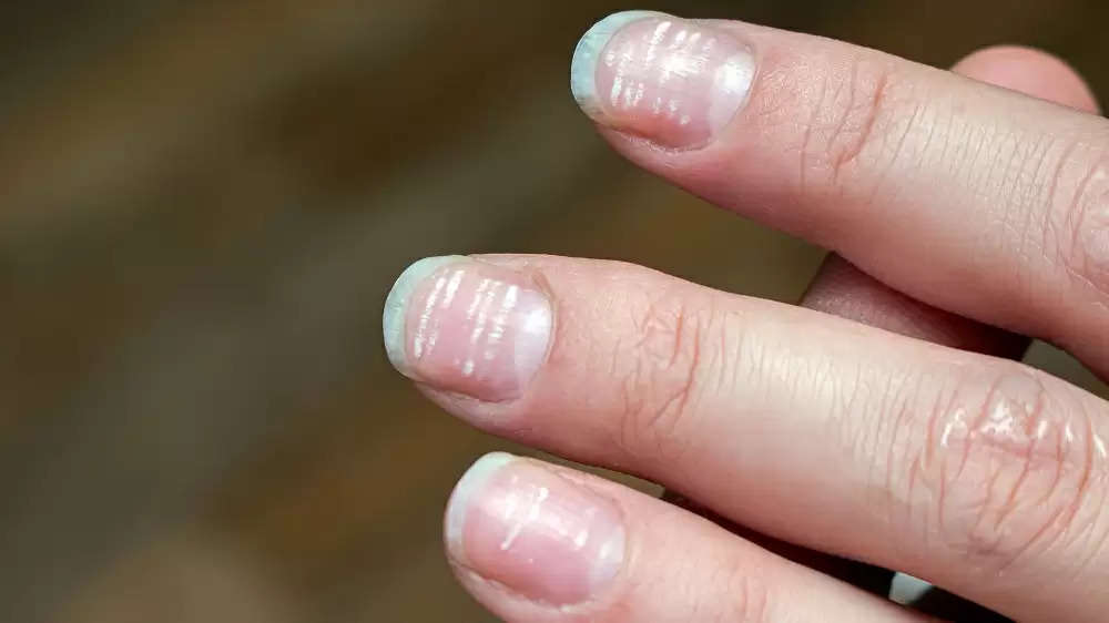 White Spot on Nails: These marks of nails tell your character and fortune,  know what oceanic scriptures say..