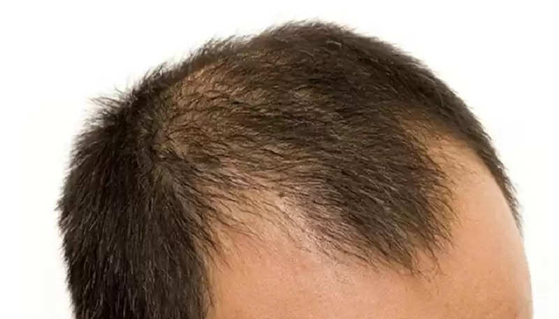 Hair Loss: These things are a panacea for the problem of baldness, the  difference will be seen in a few days
