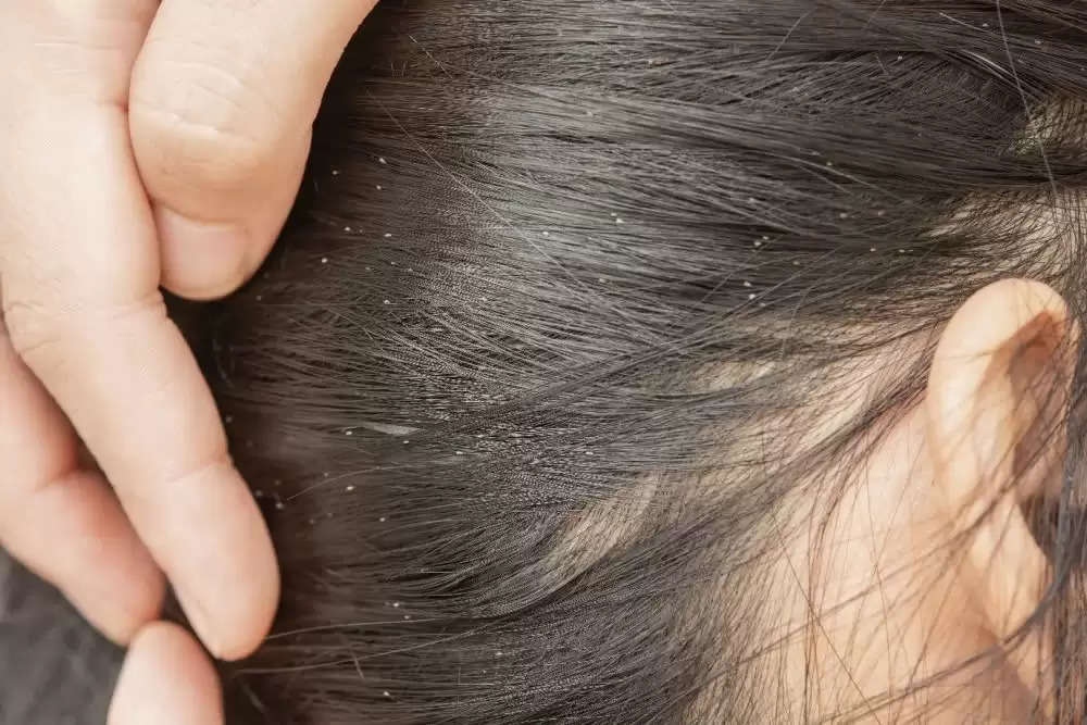 Hair Care: These 6 home tips are effective in getting rid of dandruff!