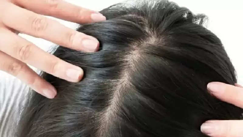 Hair Care Tips: Apply these easy home remedies to get rid of hair fall...